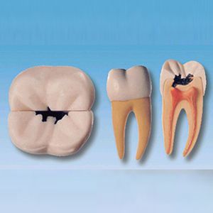 On the right side of the first molar tooth decay model